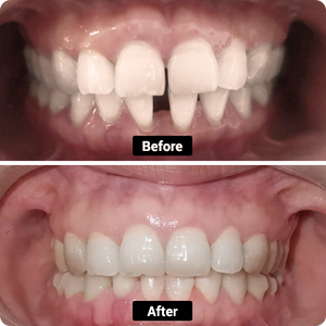 Condition: Gapped teeth