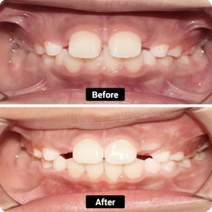 Condition: Overbite, overjet, and spaced teeth