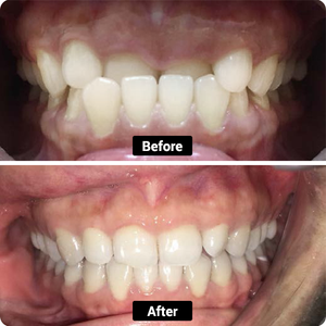 Condition: Deep underbite and crowded