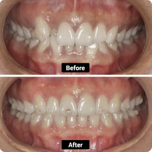 Condition: Crossbite