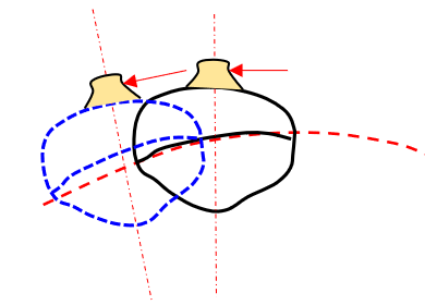 Mesial and Distal Translation